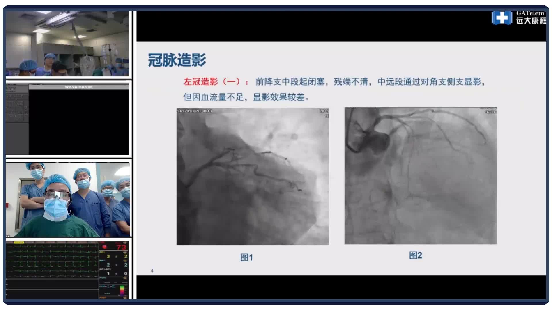 手术演示：前降支CTO一例