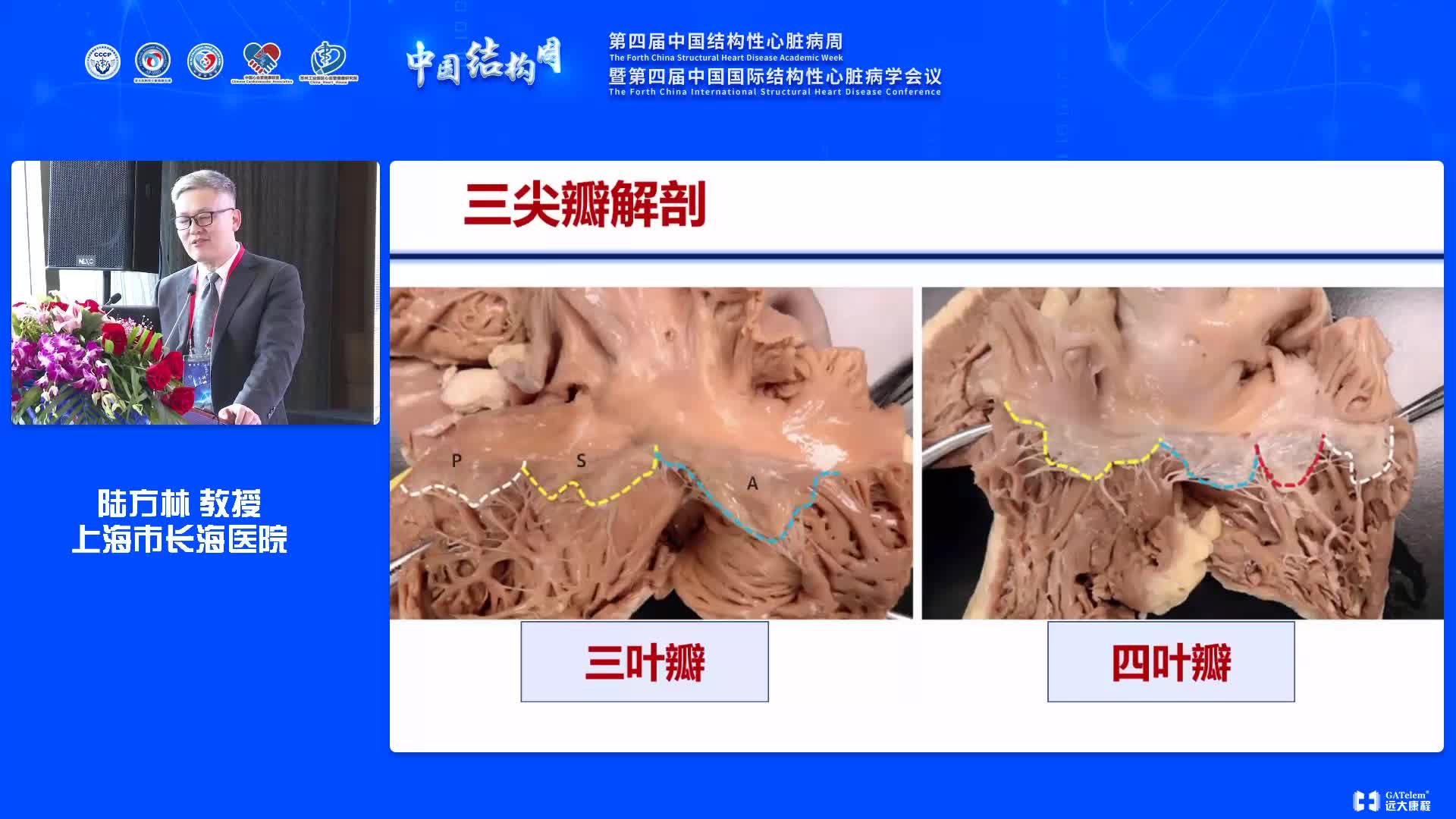 陆方林-三尖瓣反流的机制及介入治疗适应证 