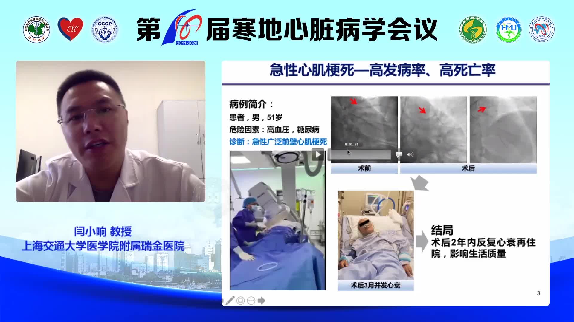 闫小响-巨噬细胞膜受体与急性心肌梗塞